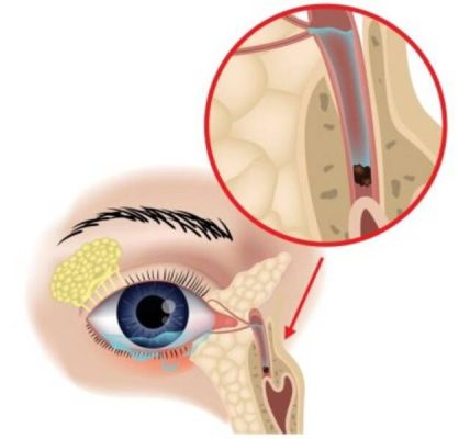 Katılık: karakterizasyonu, nedenleri ve tedavisi