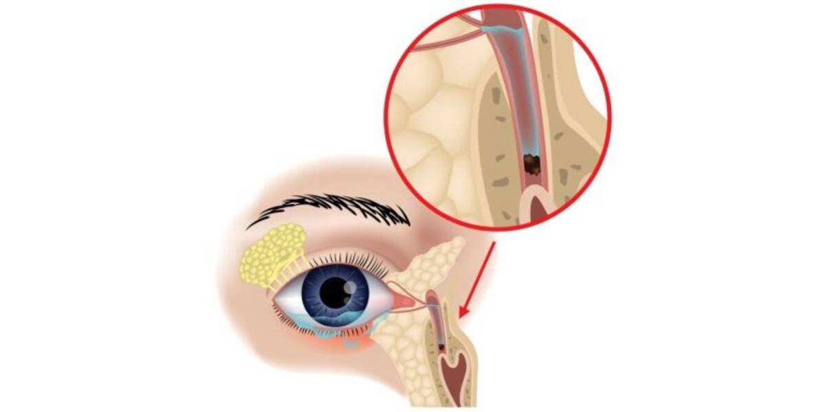 Katılık: karakterizasyonu, nedenleri ve tedavisi